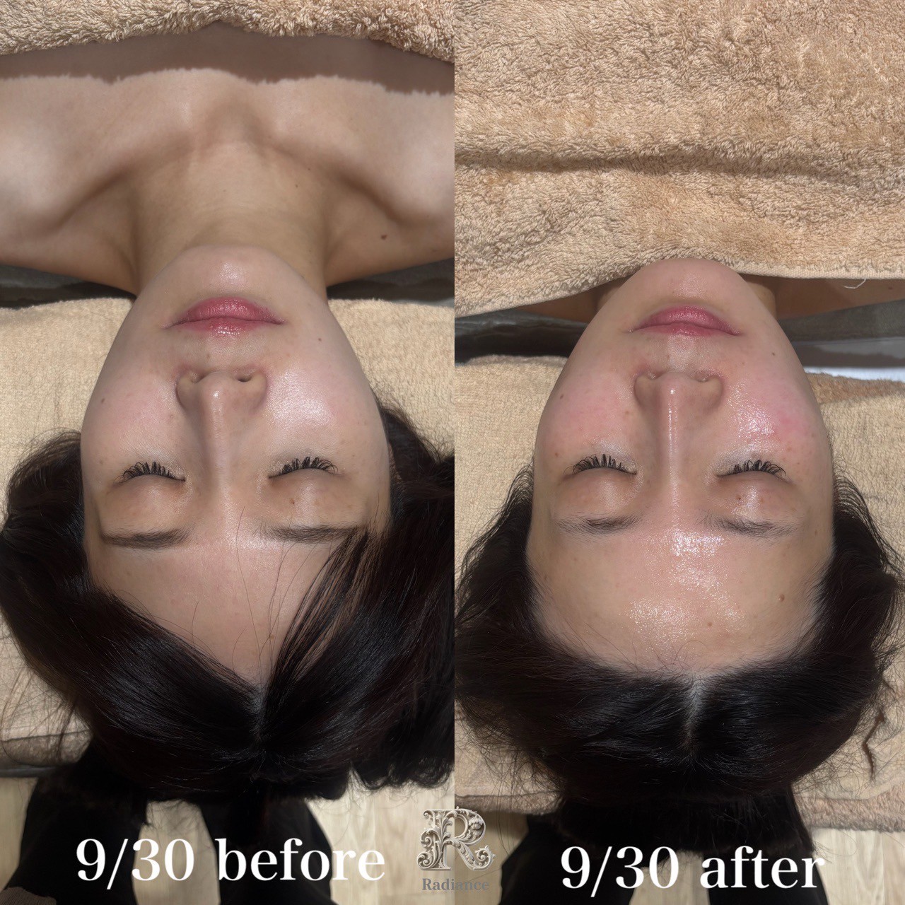 Radianceのフェイシャル施術ビフォーアフター|肌のツヤとキメが改善した実際のお客様の変化